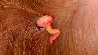 PILAR CYST EXTRAVAGANZA!