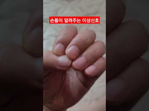 손톱에 나타나는 이상신호