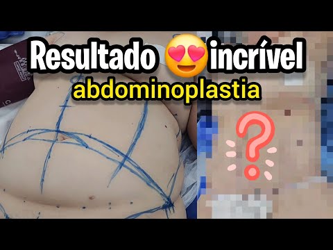 MAMÃE 2 FILHOS FEZ ABDOMINOPLASTIA E TRANSFORMOU ABDÔMEN!! Olha esse resultado!!!