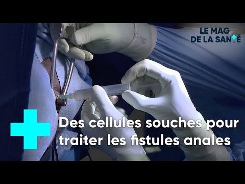 La greffe de cellules souches pour réparer les fistules anales - Le Magazine de la Santé