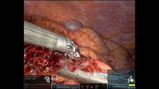 Robotic Small Bowel Resection with Intracorporeal Anastomosis: An Updated Method