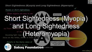 Short Sightedness (Myopia) and Long Sightedness (Heteromyopia)