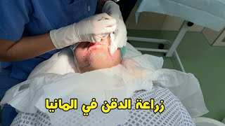 زراعة الدقن في المانيا / وزراعة الشعر