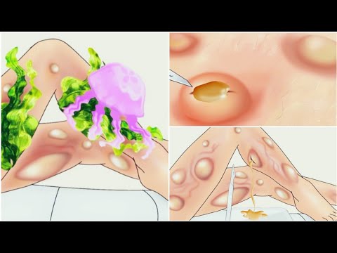 animation 《ASMR》Treatment of injured legs /Remove pimples  /Deep cleaning