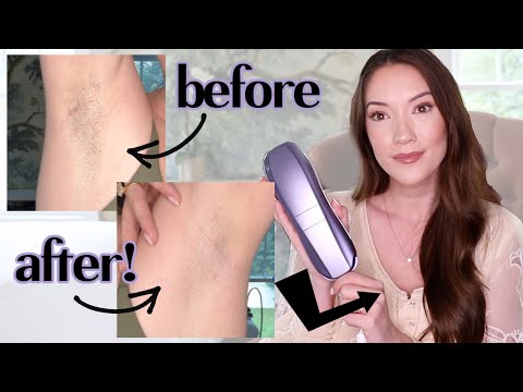 I tried laser hair removal at home... this is what happened...