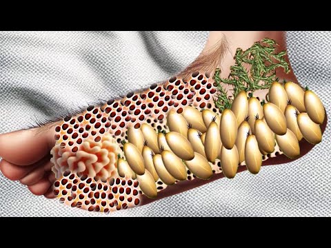 ASMR ANIMATION FOOT TREATMENT 😑😑 #543