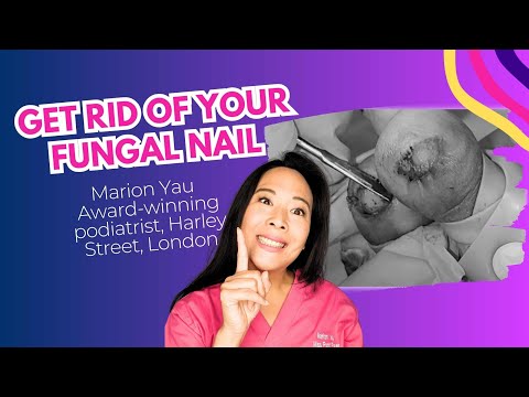 How to TREAT Fungal Nail | Get Rid Of Nail Fungus