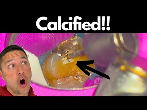 They don’t teach THIS tip in SCHOOL.  (Simplified Calcified Max Molar Technique)