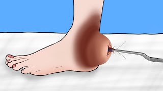 ASMR Remove cockroach from rear Foot cyst animation