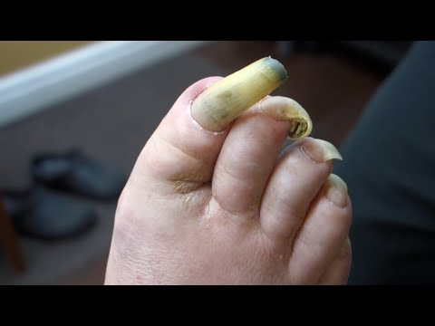 my toenail won't stop growing...