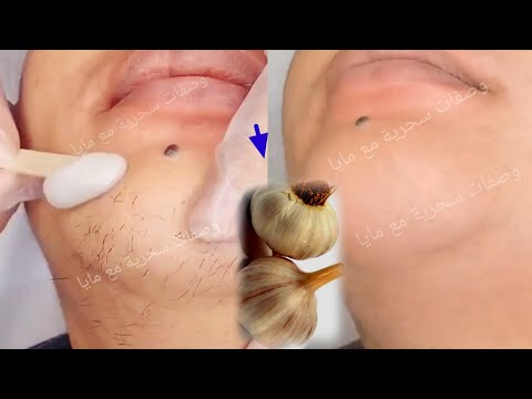 توقفي عن الحلاقة! هذه اسهل طريقة لإزالة شعر الوجه والجسم والعانة، سيسقط الشعر لوحده بدون ألم تفتيح