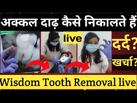 Akkal Dadh Kaise Nikalte Hai🦷 |Wisdom Tooth Removal |अकल दाढ़ निकलवाए या नहीं |दाढ़ निकलने का खर्चा