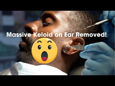 Watch As I Remove a Stubborn Ear Keloid – Step-by-Step!
