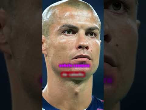 jogadores de futebol que ficaram calvo