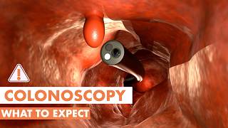 What Happens During a Colonoscopy? | 3D animation