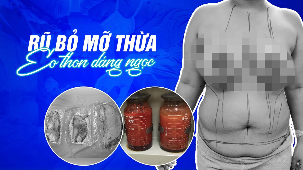 Trực tiếp kiểm tra vóc dáng quá khổ "béo lâu năm" cơ địa khó giảm bằng công nghệ hút mỡ tiên tiến