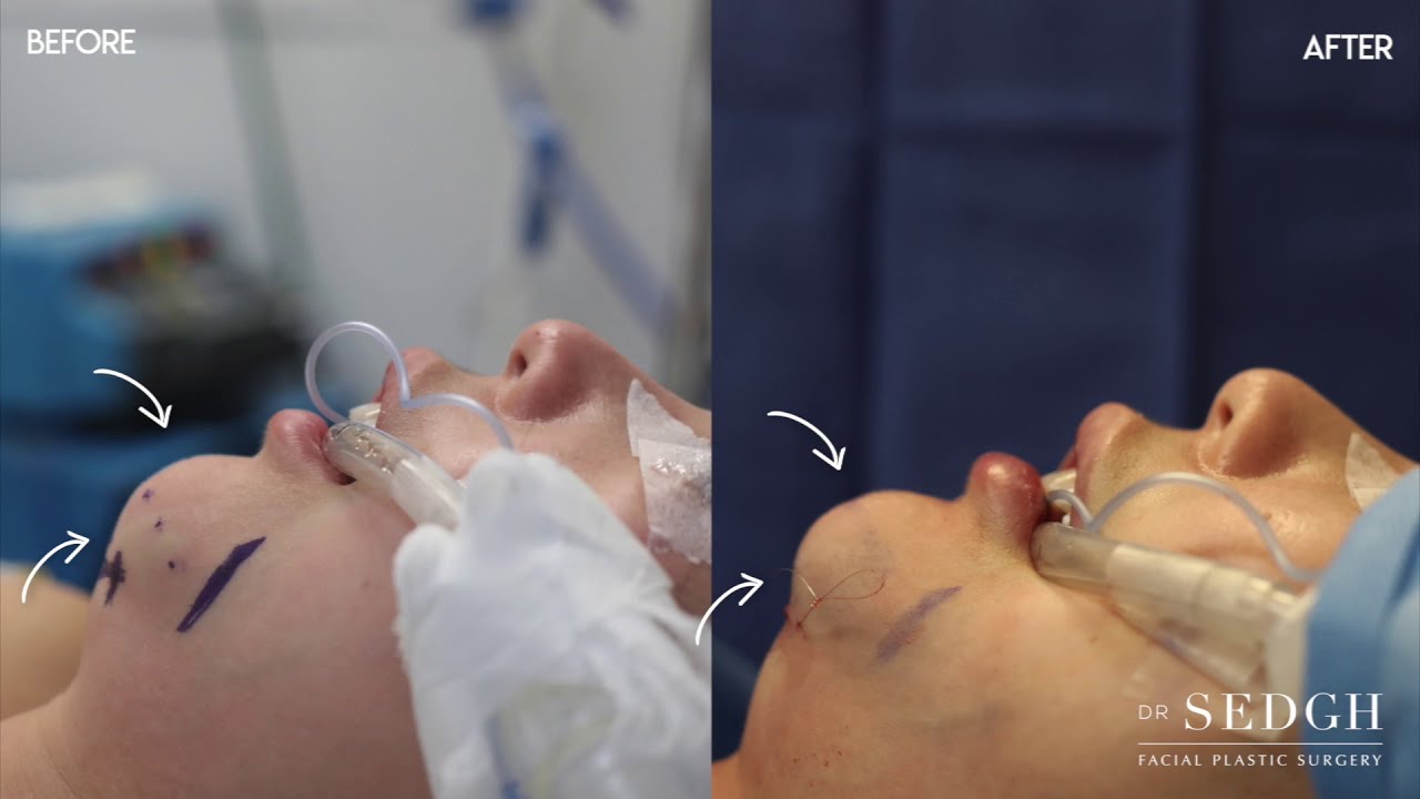 Female Chin Implant Dr Sedgh Plastic Surgery