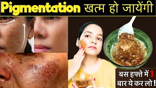 कितने भी मुश्किल झाइयाँ Hyperpigmentation, काले धब्बे Spots Melasmaहो, इस Remedy से होगा 100% इलाज |