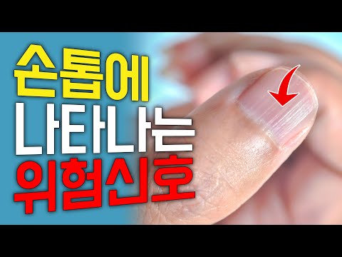 손톱에 '이런 줄' 보이면 암이 올 수 있다고 합니다