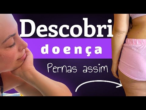 DESCOBRI PORQUE TENHO TANTA GORDURA NA PERNA | LIPEDEMA