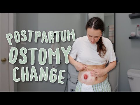 Postpartum Ostomy Change - My Stoma is Starting to Shrink! | Let's Talk IBD