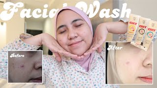 FACIALWASH UNTUK KULIT BERJERAWAT! BYE JERAWAT! OXY untuk acne prone skin!