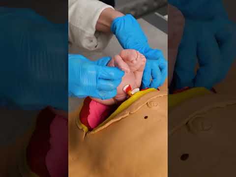 Beautiful video of C-section delivery 😍