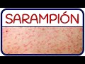 Sarampión: Preguntas Clave sobre el Virus