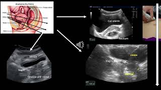 Echographie digestive visualisation du rectum: Difficile !