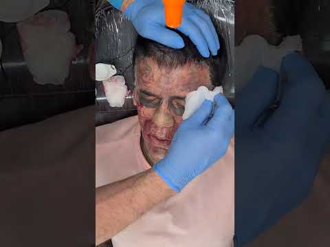 Leandro Part. 2 | Remoção de Tatuagem
