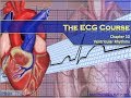 Ventricular Rhythm Characteristics and Treatment