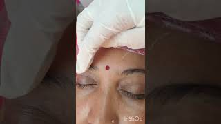 xanthelasma permanent removing lesar surgery #bydrtanjilaahamed #naturalcureclinic #multist May 2026