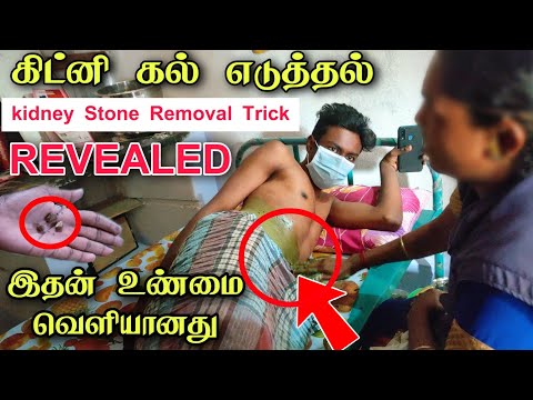 கிட்னி கல் எடுத்தல் ரகசியம் வெளியானது  | kidney stone treatment in Tamil | Edison vlogs