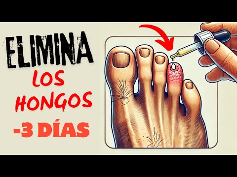 ESTA SOLUCIÓN es 100 Veces + EFECTIVA | ACABA los HONGOS EN LAS UÑAS en 3 días