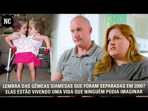 Lembra das gêmeas siamesas que foram separadas em 2006? Elas estão vivendo uma vida que ninguém