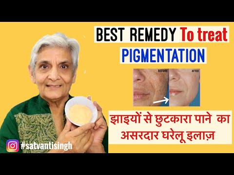 Homemade face mask for hyperpigmentation, झाईयों से छुटकारा पाने के लिए घर का बना फेस पैक
