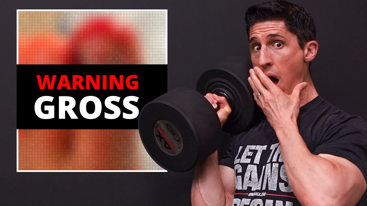 I Dropped a 95 lb Dumbbell on My Toe! (HERE'S WHAT HAPPENED)