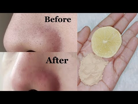 Oily skin blackheads and acne removal | Home remedies for oily skin and blackheads and whiteheads