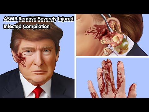 WORST Infected Injuries You Won't Believe