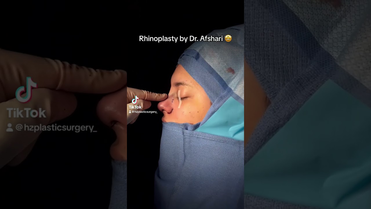 Rhinoplasty procedure demonstration with Dr. Afshari.