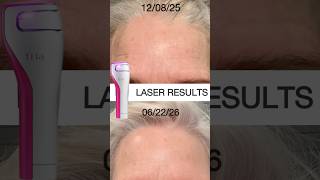 Don't Miss This! Best Home Laser for 50+ #laser #over50 #smoothskin