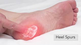 Can Bymar Shoes Custom Orthotics Help Stop Foot Pain?
