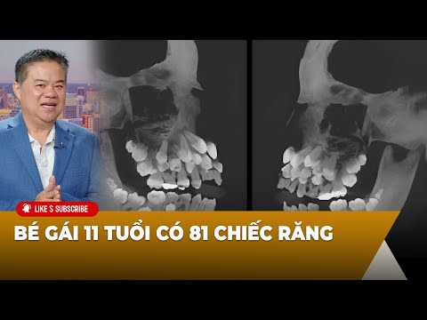 Cà Phê Sáng P5 (07-15-2025) ʙé ɢáɪ 𝟷𝟷 ᴛᴜổɪ ᴄó 81 chiếc răng