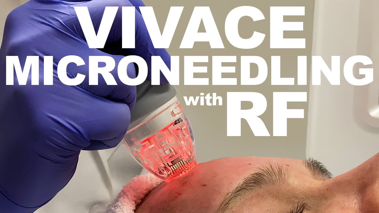 Vivace microneedling treatment in progress.