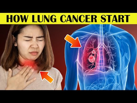 4 Critical Lung Cancer Symptoms You Shouldn't Ignore