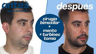 Apnea del sueño: de 30 a 4 episodios tras cirugía bimaxilar | Caso real