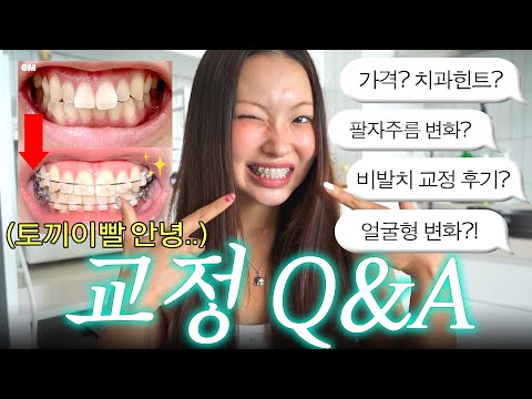 교정 6개월차의 리얼 후기..😬 가격, 얼굴형 변화, 교정 꿀팁 총정리 큐앤에이🦷