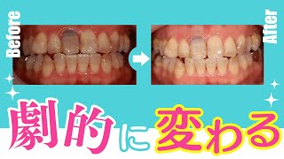 神経のない歯をホワイトニング！？