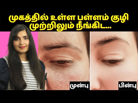 Instant OPEN PORES Removal | How To Get Rid of LARGE PORES in 3 Days | 100% Results |  #OpenPores
