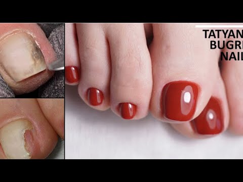 Black Toenail?! 😱 Transformation Pedicure W/ Gel